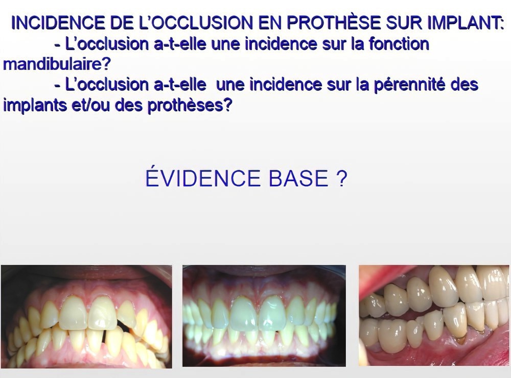 Implantologie dentaire et occlusion