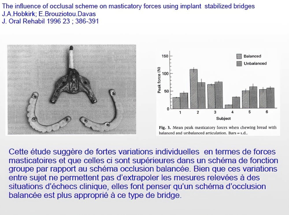 Implantologie dentaire et occlusion