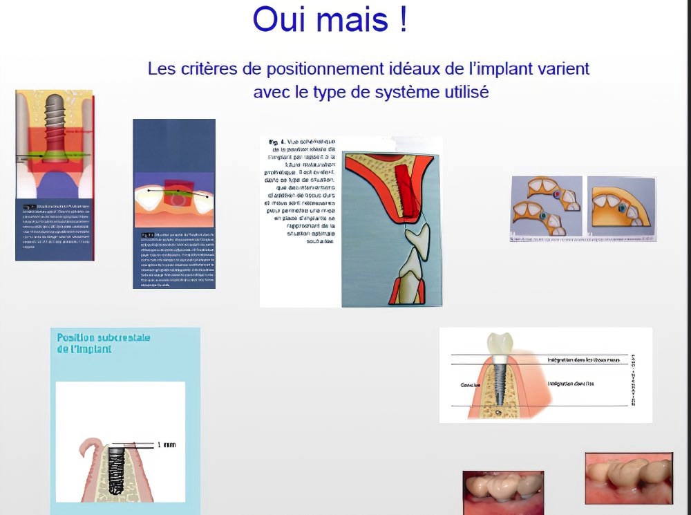 Implantologie dentaire et occlusion