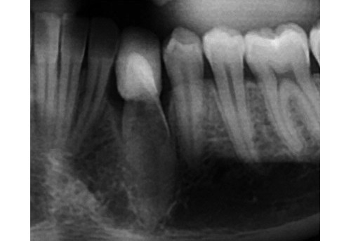 Traitement dent ankylosée