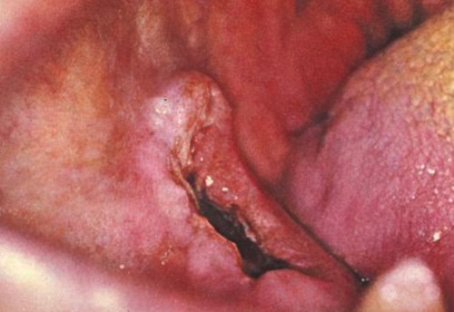 Epitélioma térébrant des maxillaires