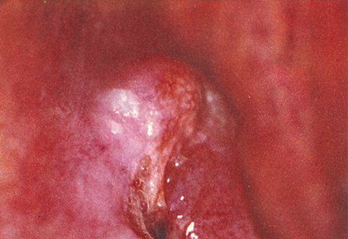 Epitélioma térébrant des maxillaires