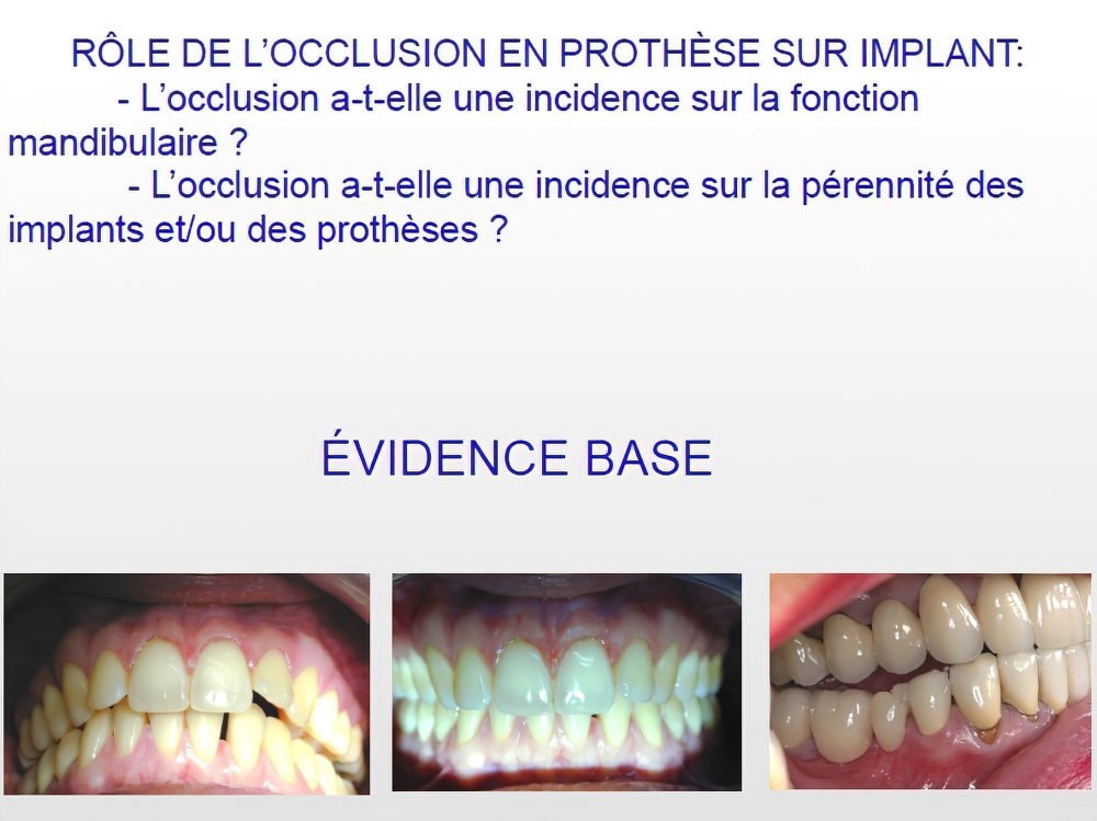 Implantologie dentaire et occlusion