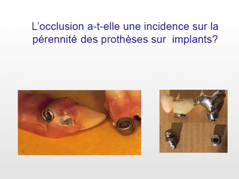 Implantologie dentaire et occlusion