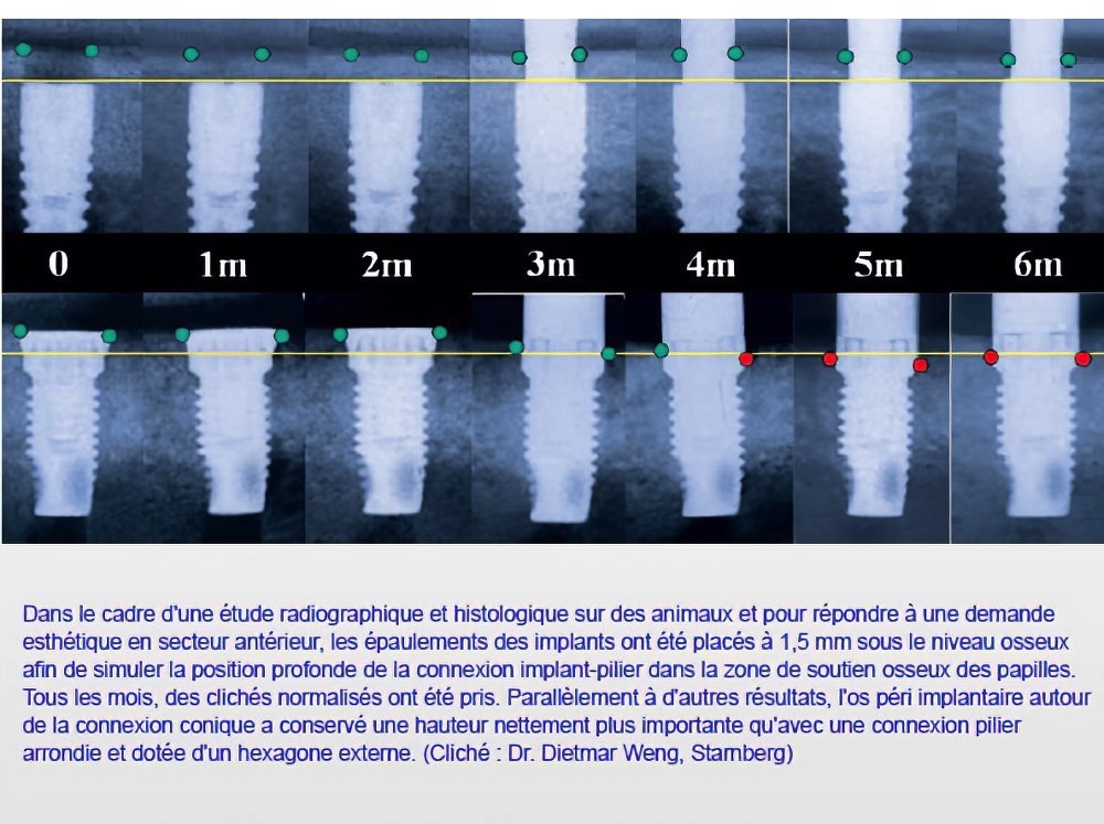 Implantologie dentaire et occlusion