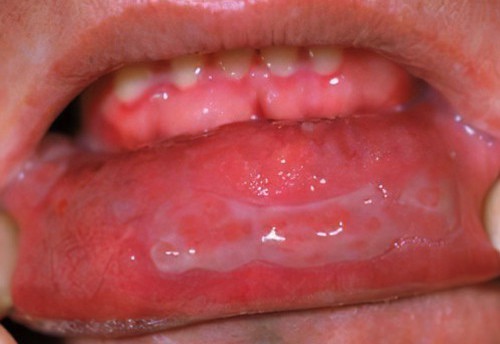 Pemphigus